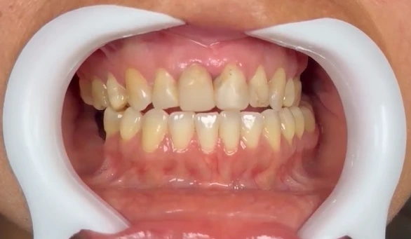 Antes do tratamento com lentes de contato dental realizado pelo Dr. Pablo Winckler em Parauapebas