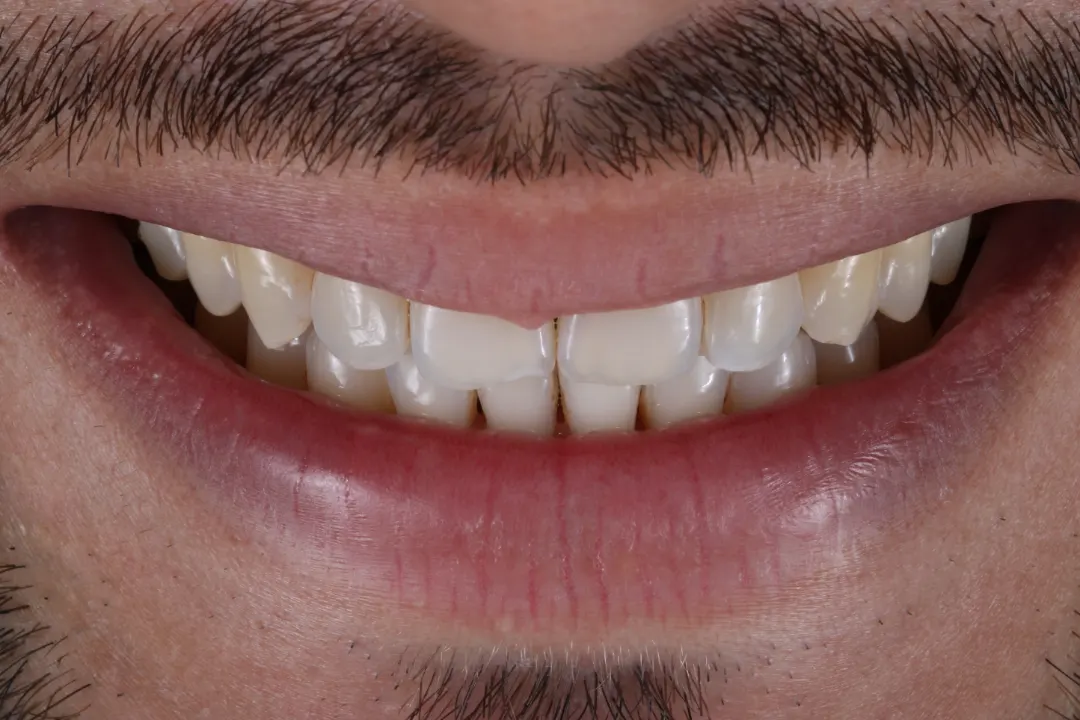Antes: sorriso do paciente em vista frontal