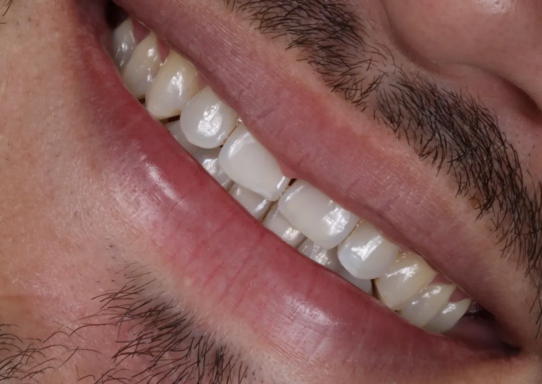 Antes: sorriso do paciente em vista lateral