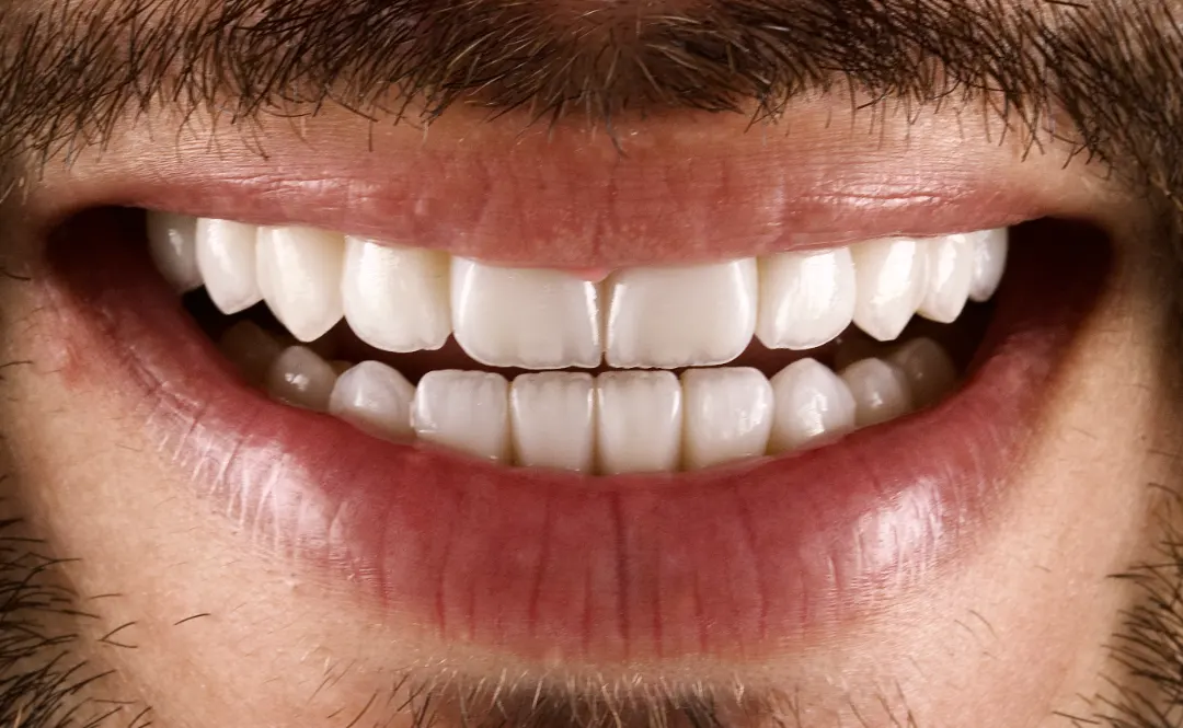 Depois: sorriso do paciente em vista frontal