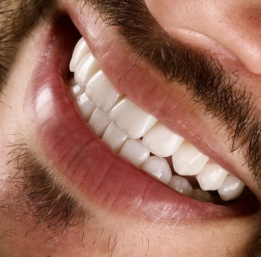 Depois: sorriso do paciente em vista lateral