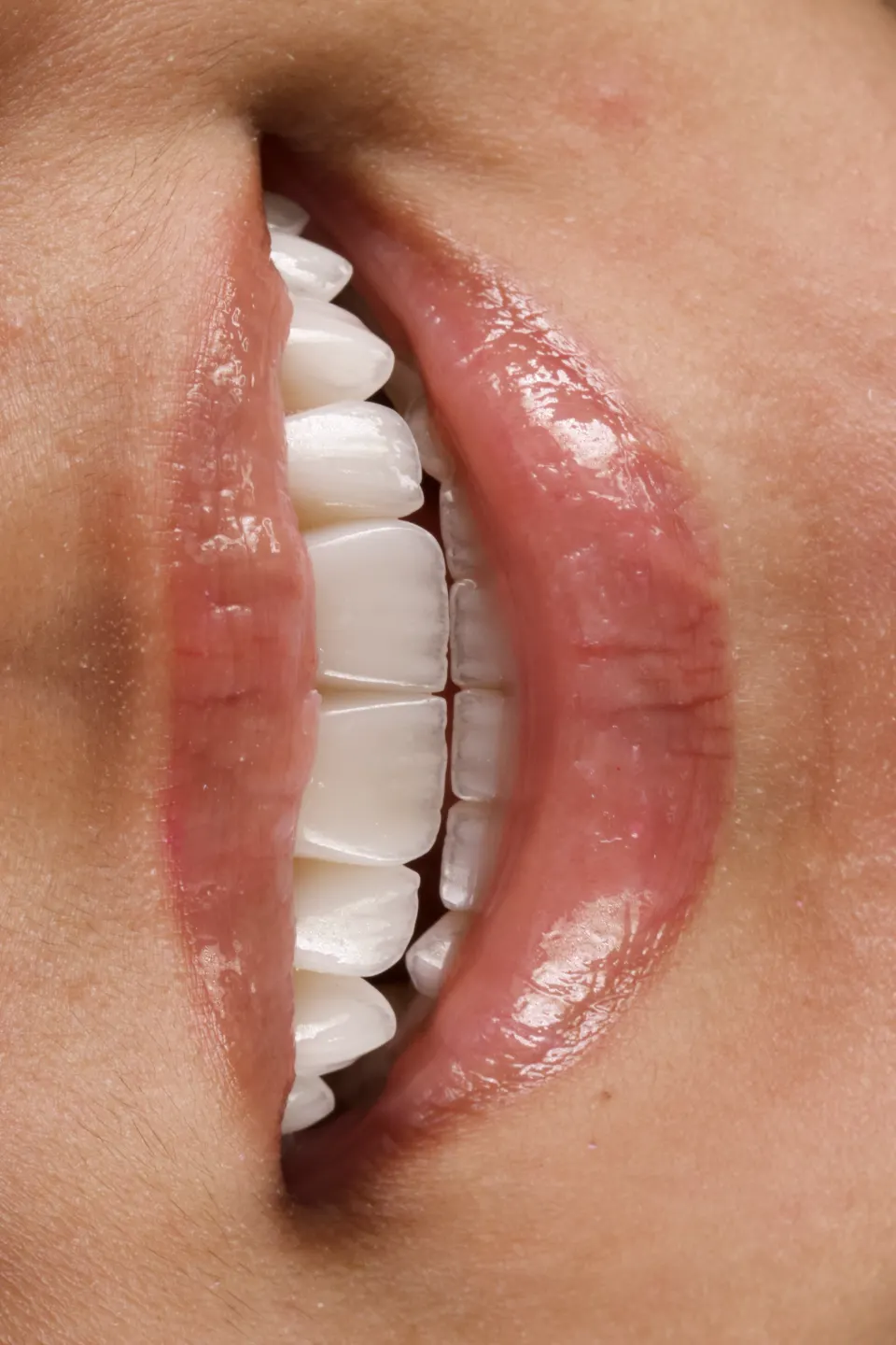 Macrofotografia de dentes com lentes de porcelana, vista aproximada