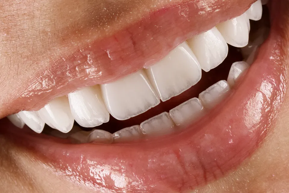 Detalhe do contorno e da borda incisal em macrofotografia