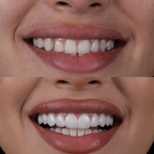 sorrisos-antesdepois-pablowinckler