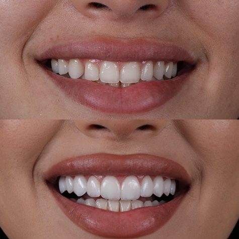 sorrisos-antesdepois-pablowinckler